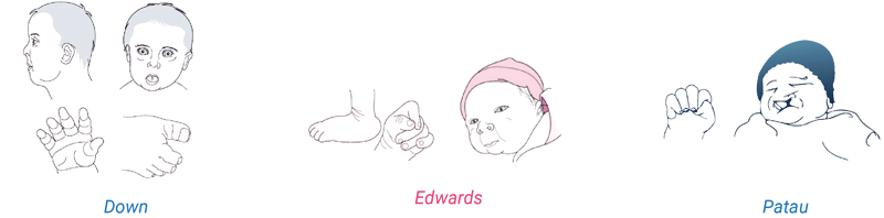 độ chính xác của xn nipt