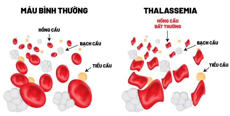 Hồng cầu bất thường khi bị Thalassemia