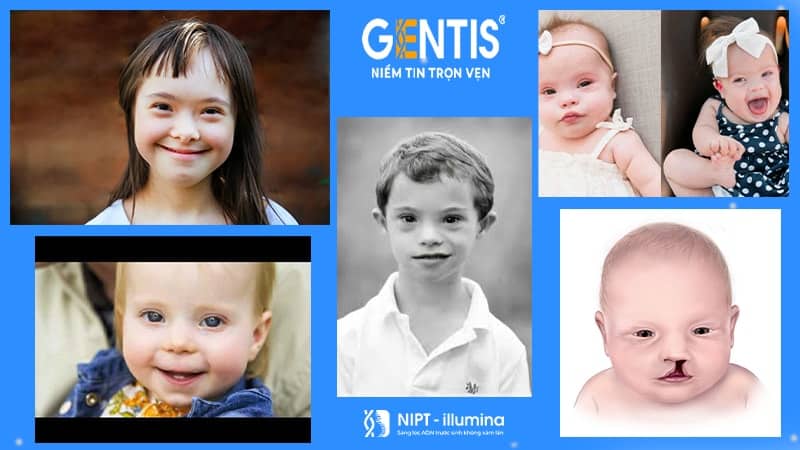 Xét nghiệm sàng lọc trước sinh nipt