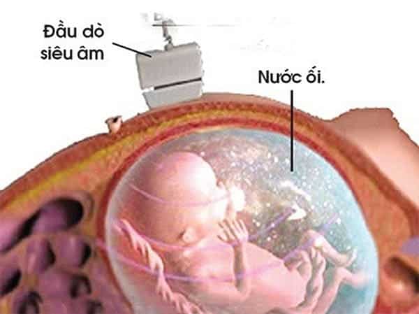 Xét nghiệm ADN thai nhi bằng phương pháp chọc ối