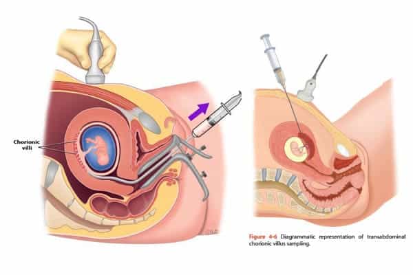 Xét nghiệm ADN thai nhi bằng phương pháp sinh thiết gai nhau